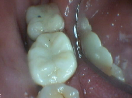 Before  Bruxir Crowns before  Bruxir Crowns