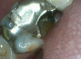 After  Bruxir Crowns after  Bruxir Crowns